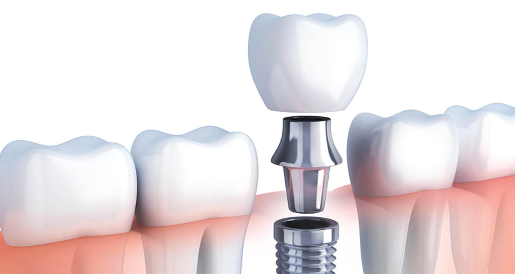 Best Dental Implants In Abu Dhabi Dental Implants Abu Dhabi