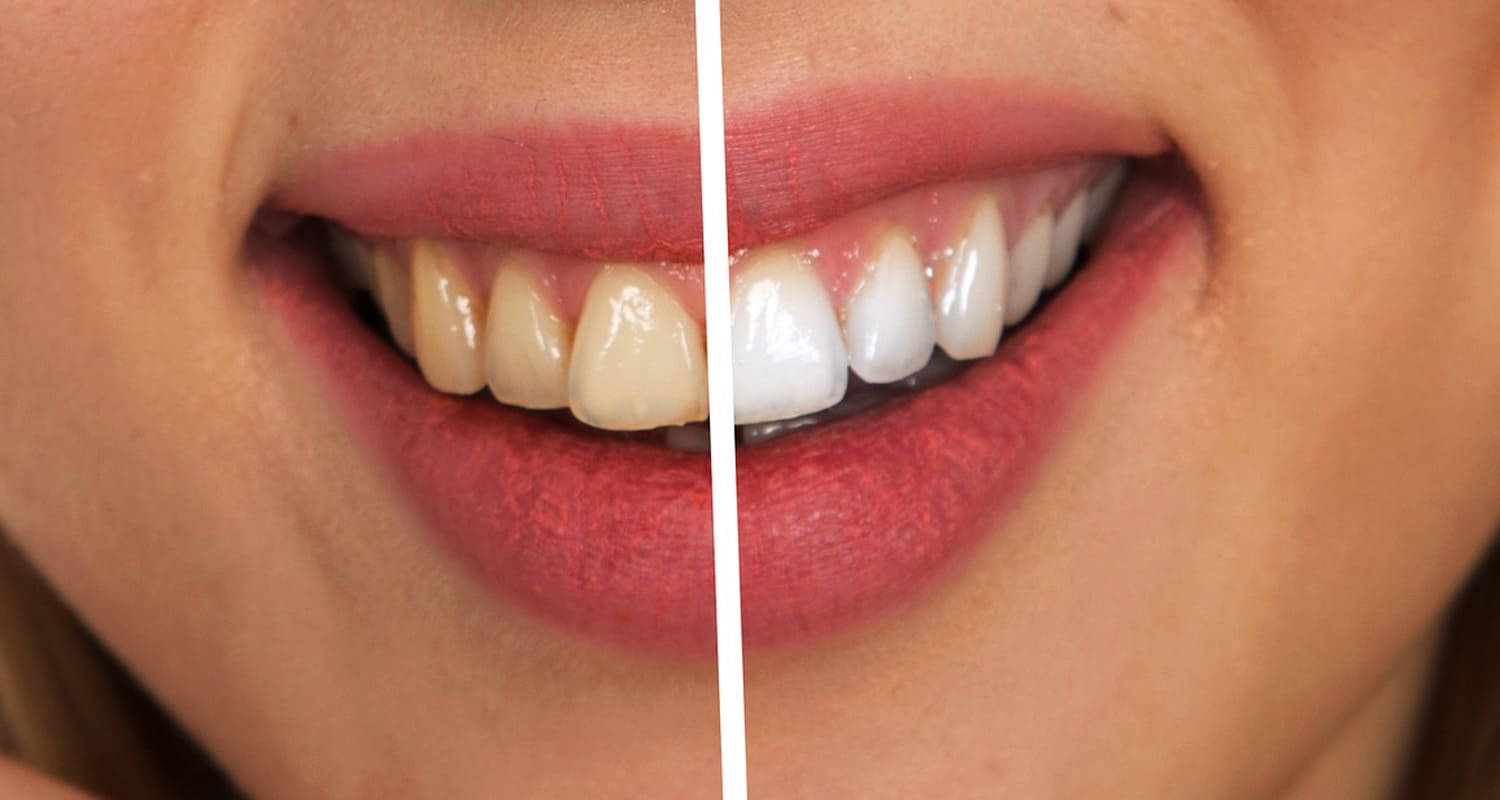 Facts about whitening